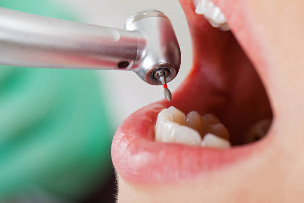 Best Emergency Broken Tooth Repair in Great Falls, SC